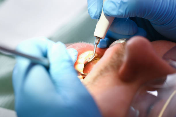 Best Emergency Dentist for Lost Fillings or Crowns in Kewaunee, WI